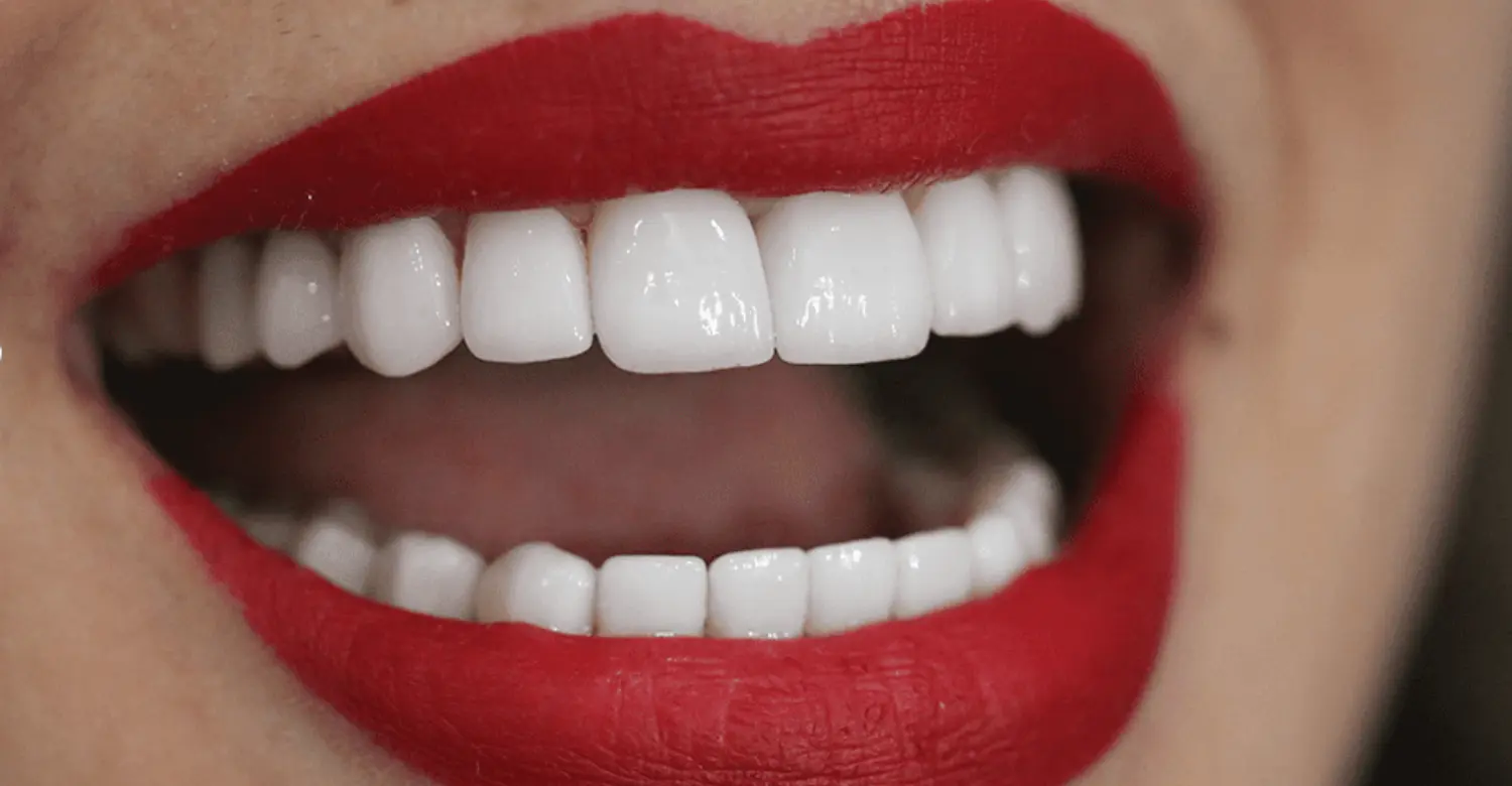 How Is Hollywood Smile Done 2